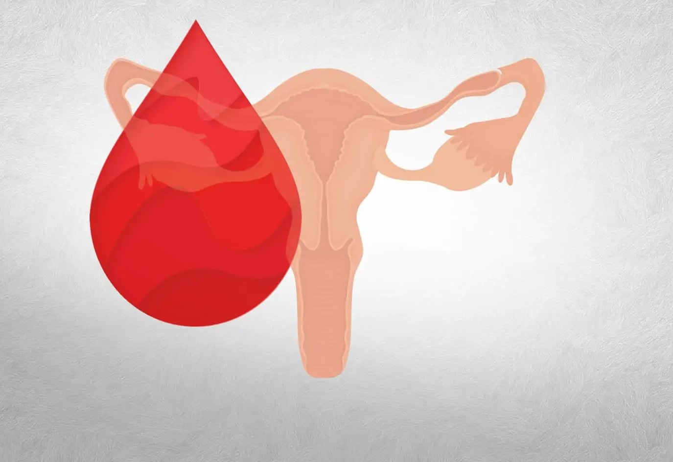 Sangramento Uterino Disfuncional - Dra. Iramis Maria Camejo Solano