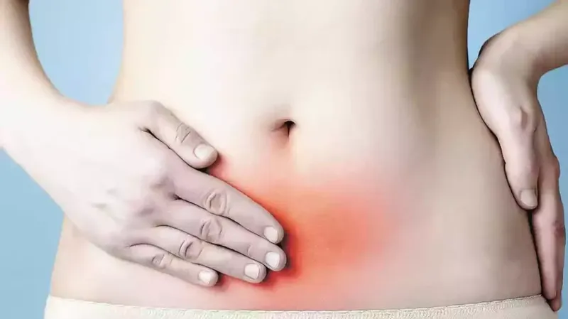 Endometriose - Dra. Iramis Maria Camejo Solano