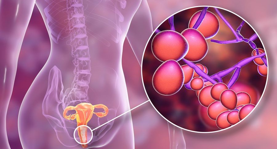 Vulvovaginites - Dra. Iramis Maria Camejo Solano